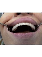 Dental Bridges - Lege Artis Dental Clinic