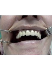 Dental Bridges - Lege Artis Dental Clinic