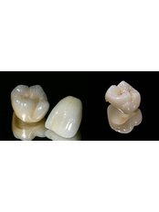Zirconia Crown - Macedonia Dental