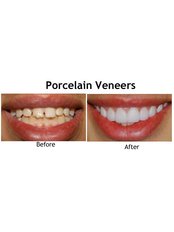Porcelain Veneers - City Dent