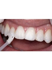 Fluoride Therapy - City Dent