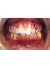 Gingivitis Treatment - City Dent
