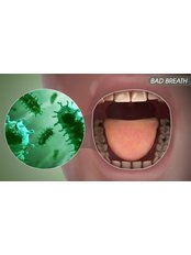 Bad Breath Treatment - City Dent