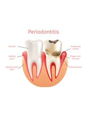 Periodontitis Treatment - City Dent