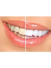 Teeth Whitening - City Dent