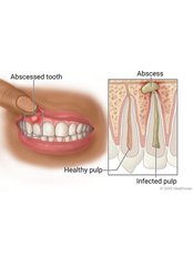 Treatment of Dental Abscess - City Dent