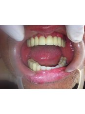 All-on-4 Dental Implants - Dental Tourism Macedonia