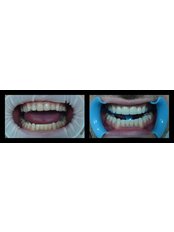 CAD/CAM Dental Restorations - DentiMax Dental Office
