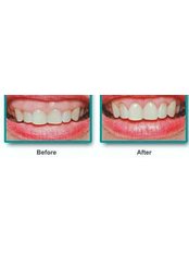 Gum Surgery - Dento-Medical