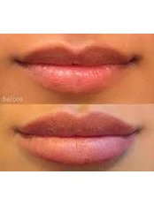 Lip augmentation  - Dento-Medical