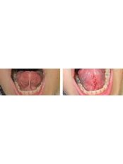 Lingual Frenectomy - Dento-Medical