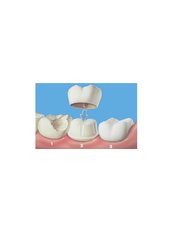 Dental Crowns - Mediana Dental Implants - Macedonia