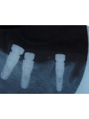 Traditional Dental X-Ray - Mediana Dental Implants - Macedonia