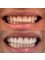 Mediana Dental Implants - Macedonia - e.Max Crowns before and after 