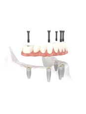 Dental Implants - Mediana Dental Implants - Macedonia