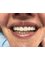 Mediana Dental Implants - Macedonia - Zirconia Crowns 