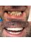 Mediana Dental Implants - Macedonia - Smile Makeover e.Max Crowns 