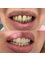 Mediana Dental Implants - Macedonia - Zirconia Crowns 