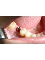 Single Implant - Mediana Dental Implants - Macedonia