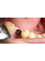Single Implant - Mediana Dental Implants - Macedonia