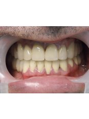 Porcelain Crown - Mediana Dental Implants - Macedonia