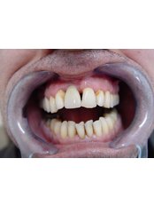Single Implant - Vita Dent