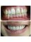 Royal Medical Center - Veneers before and after  