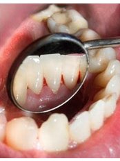 Teeth Cleaning - Bite Works Dental Care