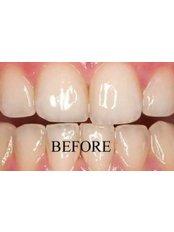 Teeth Whitening - Bite Works Dental Care