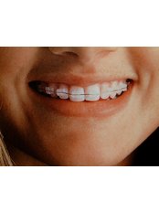Ceramic Braces - Smile Line - Specialist Dental Surgery