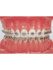 Braces - Smile Line - Specialist Dental Surgery