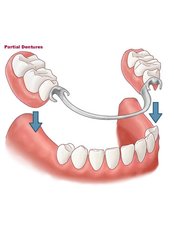 Partial Dentures @ ( Smile Line ) - Smile Line - Specialist Dental Surgery