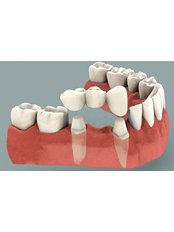 Dental Bridges - Smile Line - Specialist Dental Surgery