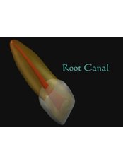 Incisor Root Canal - Smile Line - Specialist Dental Surgery