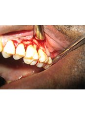 Gum Surgery - Smile Line - Specialist Dental Surgery