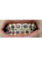 Metal Braces - Smile Line - Specialist Dental Surgery