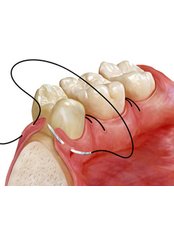 Gum Surgery @ ( Smile Line ) - Smile Line - Specialist Dental Surgery