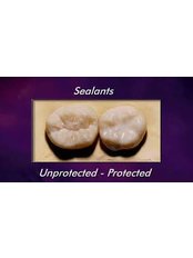 Dental Sealant - Smile Line - Specialist Dental Surgery