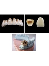 Dental Crowns - Smile Line - Specialist Dental Surgery