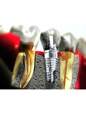 Dental Implants - Smile Line - Specialist Dental Surgery