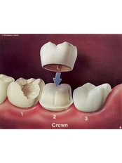 Dental Crowns - Smile Line - Specialist Dental Surgery