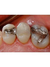 Amalgam Filling - Smile Line - Specialist Dental Surgery
