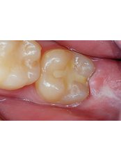 Fillings - Smile Line - Specialist Dental Surgery