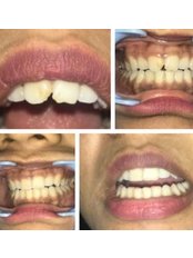 Fillings - Tooth Care Experts