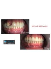 Dental Bridges - Tooth Care Experts