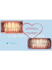 Laser Teeth Whitening - Tooth Care Experts