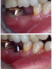 Dental Implants - Clínica Sanmartin