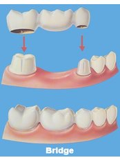 Dental Bridges - Peru Dental