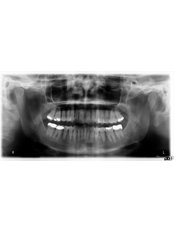 Digital Panoramic Dental X-Ray - Peru Dental