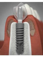 Oral and Maxillofacial Surgeon Consultation - Peru Dental